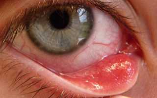 Кератит глаза