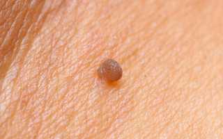 Папилломы и паразиты