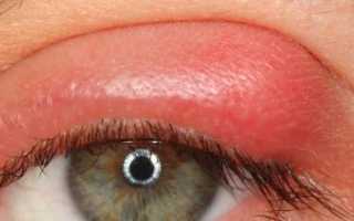 Как выглядит ячмень? Профилактика и лечение болезни