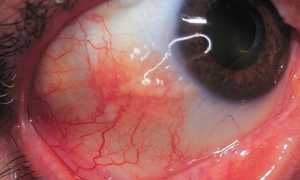 Симптомы эписклерита, методы терапии патологии