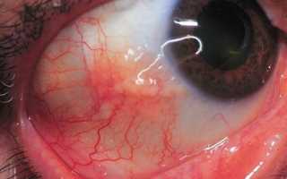 Симптомы эписклерита, методы терапии патологии