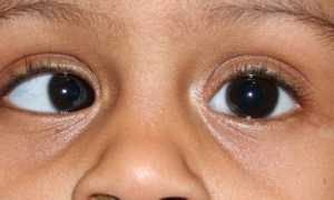 Тип сходящегося косоглазия, лечение патологии