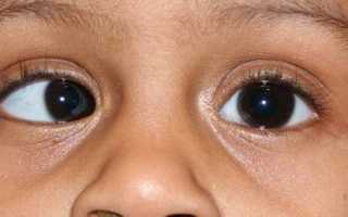 Тип сходящегося косоглазия, лечение патологии