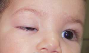 Как диагностируется и лечится врожденный птоз?
