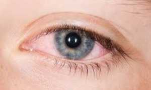 Аденовирусный конъюнктивит: виды, особенности лечения