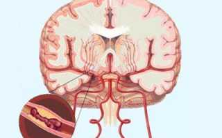 Пирацетам: причины передозировки, симптомы, последствия