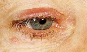 Блефарит, симптомы заболевания