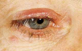 Блефарит, симптомы заболевания