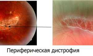 Дистрофия сетчатки глаза, что это такое?