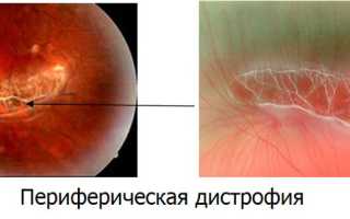 Дистрофия сетчатки глаза, что это такое?