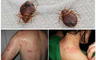 Как выглядят укусы постельных клопов на коже человека