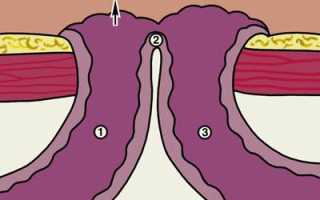 Причины каловой рвоты: лечение, последствия