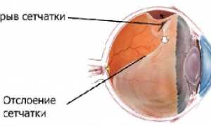 Разрыва сетчатки глаза, виды лечений
