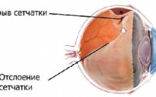 Разрыва сетчатки глаза, виды лечений