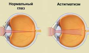 Что такое астигматизм и как он лечится