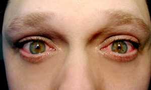 Мейбомиевый блефарит: причины, симптомы и лечение