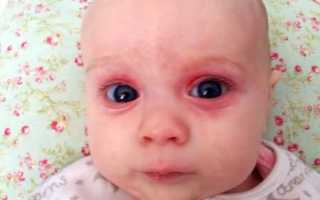 Причины появления красных кругов под глазами у ребенка