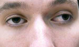 Астигматизм смешанного типа, особенности лечения