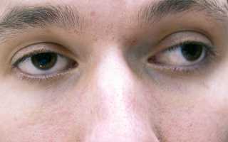 Астигматизм смешанного типа, особенности лечения