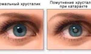 Возможные осложнения и виды лечения катаракты