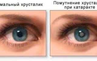 Возможные осложнения и виды лечения катаракты
