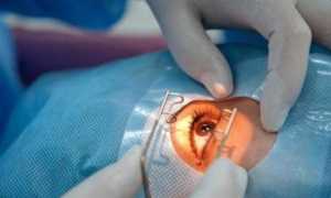 Виды удаления халязиона