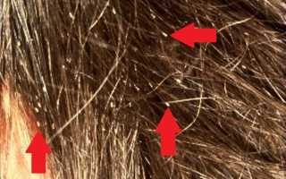 Эффективное лечение и профилактика педикулеза у детей