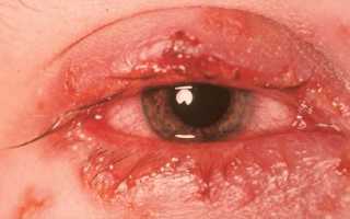 Причины и симптомы герпетического конъюнктивита