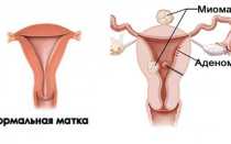Миому каких размеров надо удалять