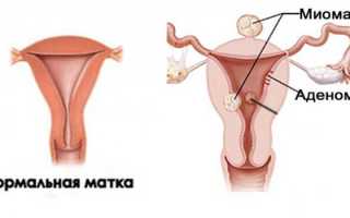 Миому каких размеров надо удалять