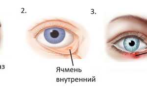 Народная медицина от ячменя, причины патологии