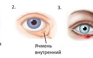 Народная медицина от ячменя, причины патологии