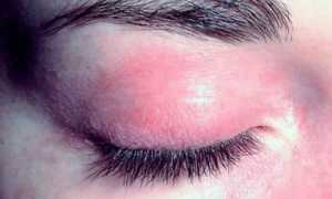 Гиперемия век у взрослого, причины и особенности терапии
