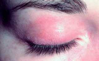 Гиперемия век у взрослого, причины и особенности терапии