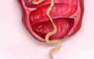 Глисты и зуд в заднем проходе