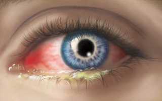 Лечение блефарита