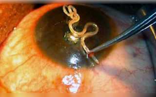 Паразитный червь-Лоа Лоа.