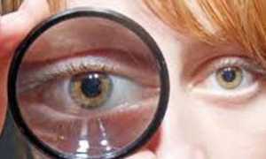 Признаки отека сетчатки глаза