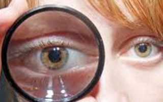 Признаки отека сетчатки глаза