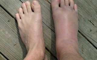 Симптомы и последствия передозировки фуросемидом