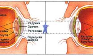 Основные признаки и симптомы катаракты