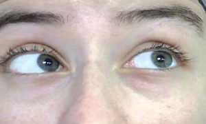 Горизонтальный нистагм