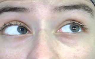 Горизонтальный нистагм