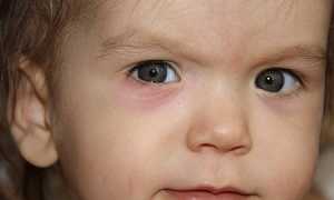 Как проявляется ячмень у ребенка? Чем лечить?