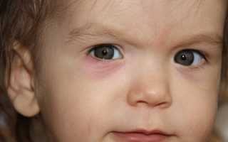 Как проявляется ячмень у ребенка? Чем лечить?