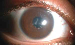 Эффективные методы лечения дистрофии сетчатки глаза