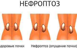 Нефроптоз почек 1 степени: причины, симптомы, диагностика и лечение