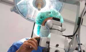 Операция для коррекции миопии