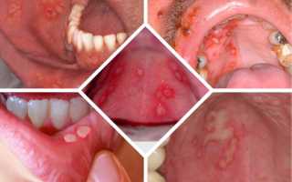 Герпес на небе