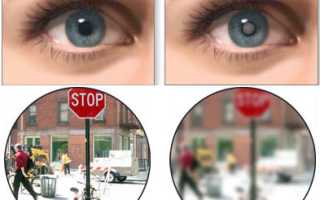 Народная медицина или хирургическое вмешательство от катаракты